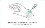 手首の甲などにできるこぶ状のしこり「ガングリオン」 | 倉石整形外科クリニック 長野市若穂 リハビリテーション科