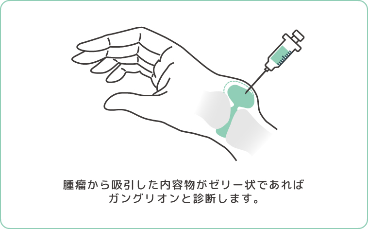 手首の甲などにできるこぶ状のしこり「ガングリオン」 | 倉石整形外科クリニック 長野市若穂 リハビリテーション科